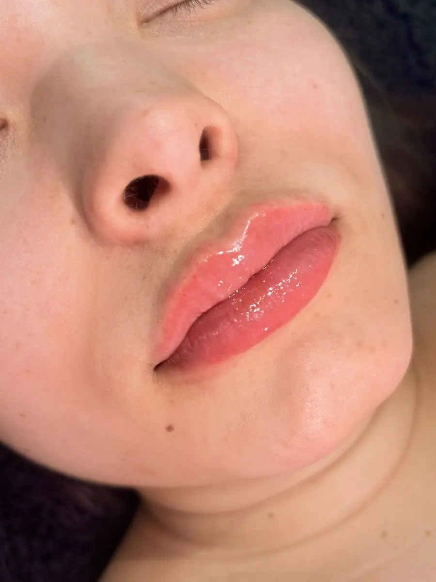 Depois — Preenchimento labial · contorno e volume sutil